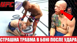 УЖАСНАЯ ТРАВМА! ПЕРЕЛОМ ЛИЦЕВОЙ КОСТИ В БОЮ СТИВЕНС - ЭММЕТТ UFC ON FOX 28