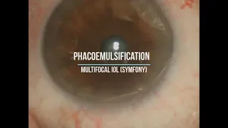Имплантация Мультифокальной интраокулярной линзы - Офтальмолог Доктор Рашадат Гурбанов