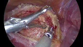 laparoscopic repair of isthmocoele ( uterine scar defect)