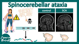 Spinocerebellar Ataxia | Pathology, diagnosis and treatment of Spinocerebellar Ataxia | USMLE