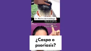 ¿Caspa o psoriasis?