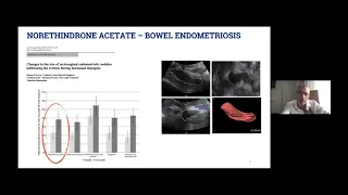 EEL Webinar: Update in hormonal treatment of deep endometriosis - Simone Ferrero
