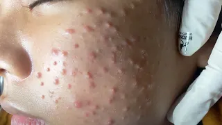 Make your Acne Treatment Huong Da Nang | 461# acne 2022