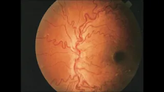 SICKLE CELL DISEASE RETINOPATHY