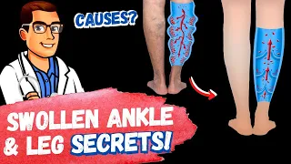 STOP Swollen Ankles & Swollen Feet [Treatment SECRETS 2022]!