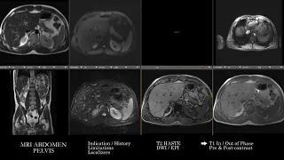 [MRI] Abdomen Pelvis | Search Pattern