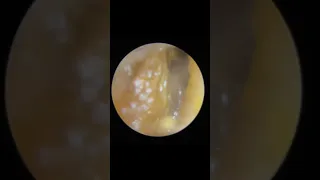5 X EAR WAX REMOVAL COMPILATION - EP723 TEASER