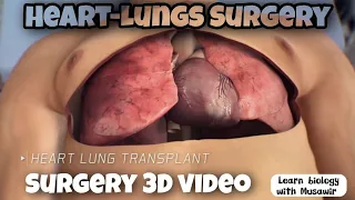 Heart-Lung Transplant ,, #surgery  ,, Removing the Heart and Lungs !. {Bio with Musawir}.