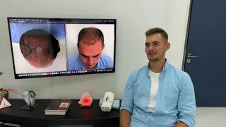 Saçekimi Sonrası Muhteşem Sonuç 10. Ay ( Önce Sonra Before After ) After Hair Transplant 10th month