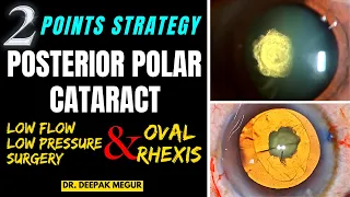 Posterior Polar Cataract: My 2-Point Strategy (Low flow, low pressure surgery & Oval Rhexis) Dr. DM