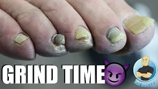 GRINDING DOWN THICK DAMAGED TOENAILS