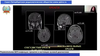 Титова М.А.Перинатальная ВИЧ-инфекция: прошлое и настоящее лучевой диагностики