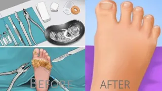 ASMR Remove fungal infection between toes | Foot care treatment animation