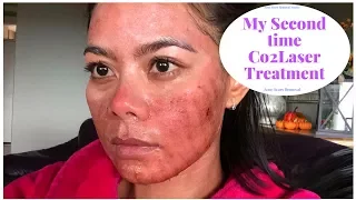 My Second Time Co2 Laser Treatment ( 7 Days Review)
