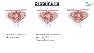 Nephrotic Syndrome vs Nephritic Syndrome