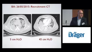 Airway Pressure Release Ventilation (APRV): Luigi Camporota, Penny Andrews, Nader Habashi