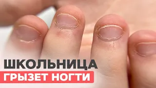 Bitten nails | Manicure for a schoolgirl