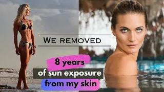 We just removed 8 years of sun exposure from my skin, permanently!! Here's how. The result = insane!