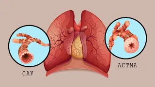Бронх демікпесі | Бронхиальная астма