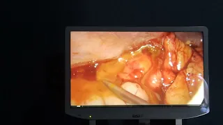 Laproscopic Drainage of Post-cholecystectomy Collection