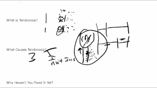 What Is Tendonosis? Why do you have it? How do you treat it?