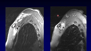 Brachial Plexus MRI, Part 1