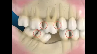 A perda de 1 dente e suas consequências
