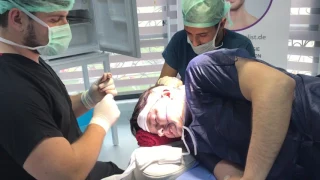 Barttransplantation in istanbul