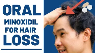 Oral Minoxidil - How Effective Is it REALLY?