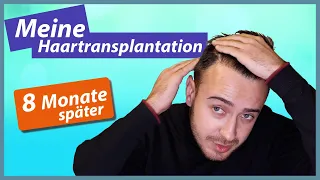 Haartransplantation Türkei  - 8 Monate Post OP | Igors Haartransplantation