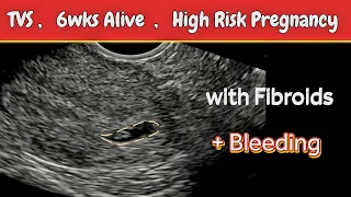 6 weeks 2 days Alive Pregnancy | TVS Ultrasound | High Risk Early Pregnancy with Bleeding