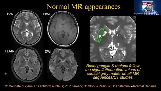 Dr Mohan  presents "imaging "metabolic (toxic) disease of the brain"   HD 1080p