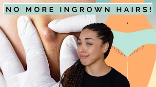 How I got rid of INGROWN HAIRS on my bikini area, FOREVER.