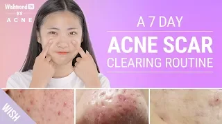 Acne Scars: How to Prevent & Quickly Remove Various Types | Wishtrend TV VS ACNE