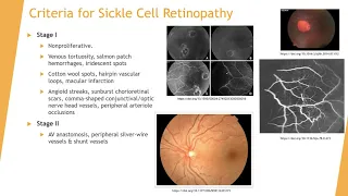 iPiece Sickle Cell Disease Part 2