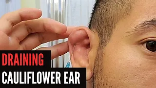 HOW TO DRAIN CAULIFLOWER EAR