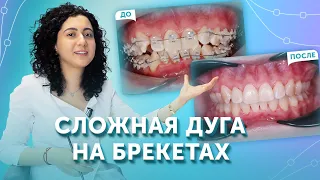 Как работает сложная дуга на брекетах