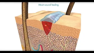 Flamigel | Optimal moist wound healing with Flamigel