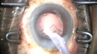 phaco-chop in hx iritis with ample reflux from Schlemm's canal during sx