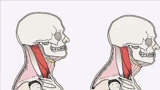 how to get rid of forward head posture