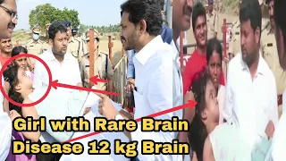 12kg Brain Girl with Rare Disease CM Jagan Mohanreddy Helped with Medical And Monthly Pension.