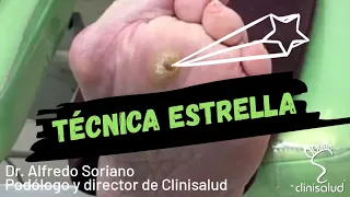 Quiropodia con "Técnica Estrella" | Podoformación