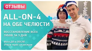 Полная трансформация улыбки «все на четырех» – отзыв через 10 месяцев