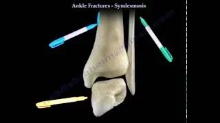 Ankle Fractures and the Syndesmosis - Everything You Need To Know - Dr. Nabil Ebraheim