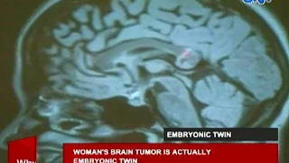 Woman's brain tumor is actually embryonic twin