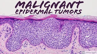 Malignant Epidermal Lesions & Mimics 101 (Carcinoma Basics - Dermatopathology Dermatology Pathology)