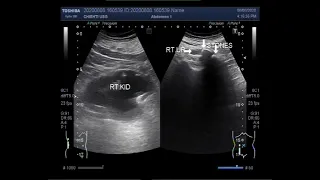 Ultrasound Video showing Two large ureteric stones.