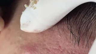 HOT HOT HOT ACNE BIG GIANT (His name is Tiến ) p3 - ĐIỀU TRỊ MỤN ĐÀ NẴNG MAI NGỌC