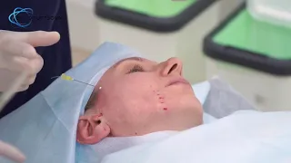 Подтяжка лица нитями APTOS по авторской методике доктора Анны Огурцовой, Vivamedical Aesthetic Club