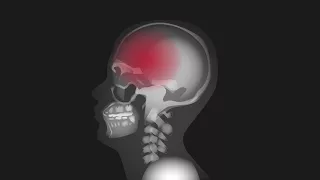 Protecting the brain after traumatic brain injury: the role of multimodality neuromonitoring